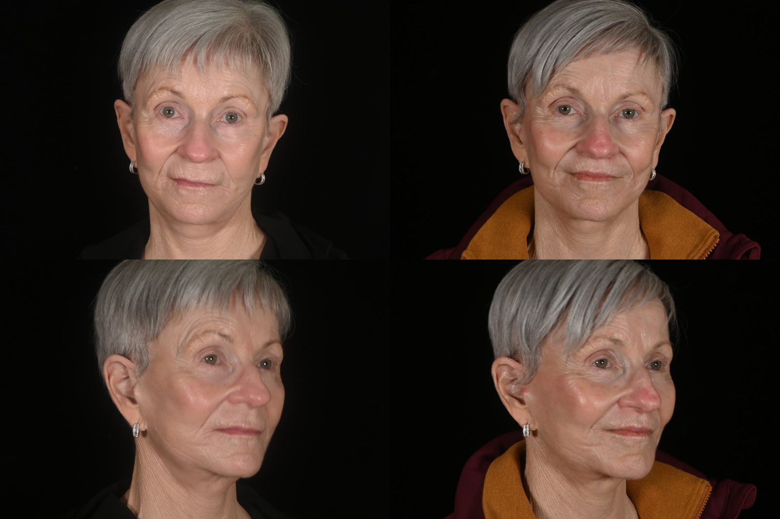 Woman, front view and three-quarter view, before and after lip lift and CO2 laser resurfacing. Left column before, right column after.