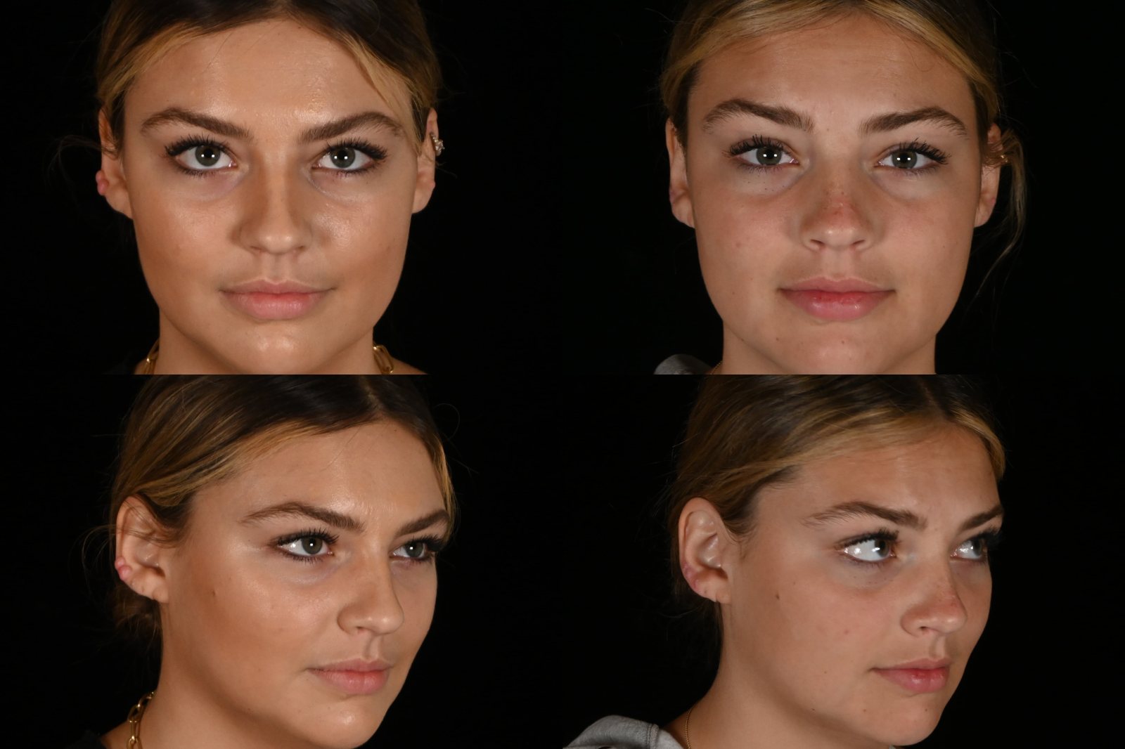 Woman, front view and three-quarter view, before and after ear keloid removal. Left column before, right column after.
