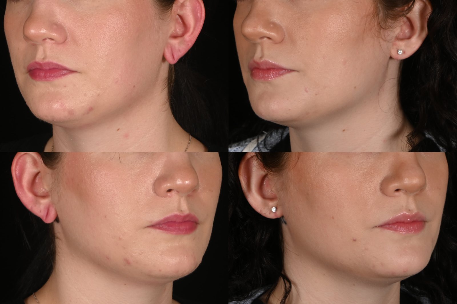 Woman, right three-quarter view and left three-quarter view, before and after earlobe repair. Left column before, right column after.