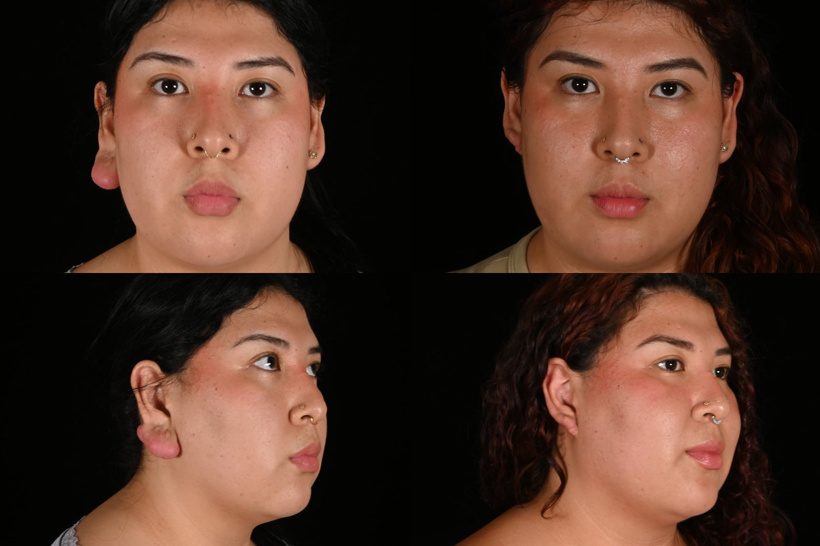 Woman, front view and three-quarter view, before and after earlobe repair. Left column before, right column after.
