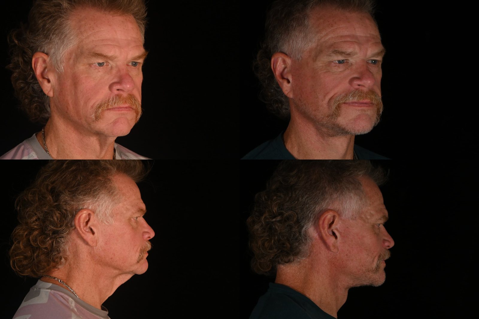 Man, three-quarter view and side view, before and after deep plane facelift and neck lift. Left column before, right column after.