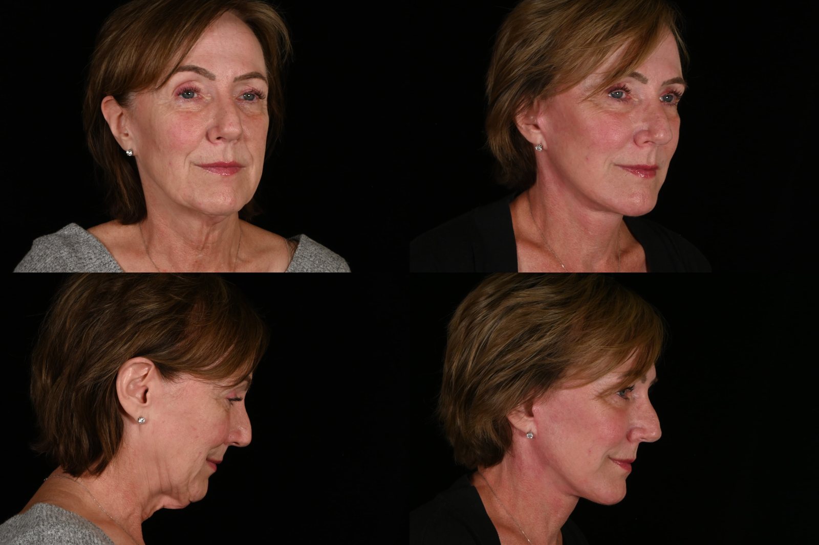 Woman, three-quarter view and side view, before and after deep plane facelift and neck lift, fat grafting and CO2 laser resurfacing. Left column before, right column after.