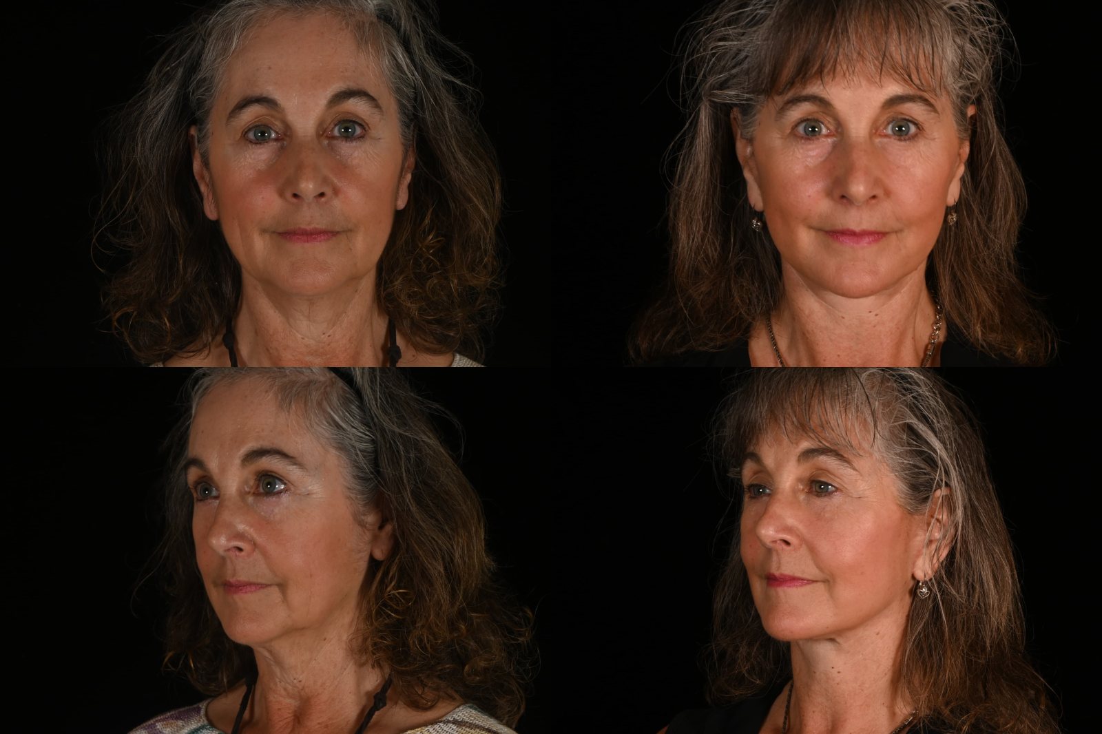 Woman, front view and three-quarter view, before and after deep plane facelift and neck lift. Left column before, right column after.