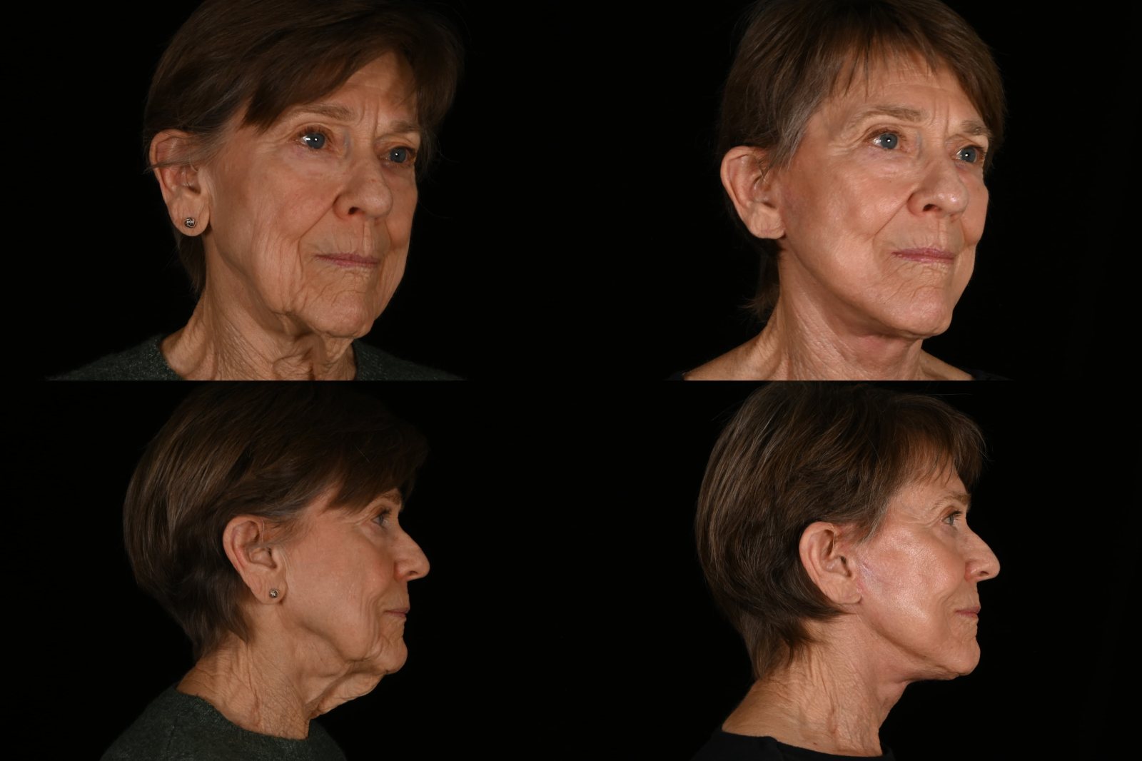 Woman, three-quarter view and side view, before and after deep plane facelift and neck lift. Left column before, right column after.