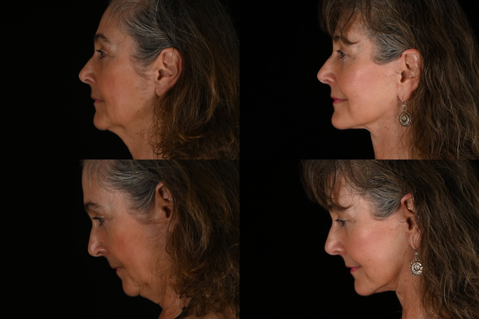 Woman, side view and side view, chin down, before and after deep plane facelift and neck lift. Left column before, right column after.