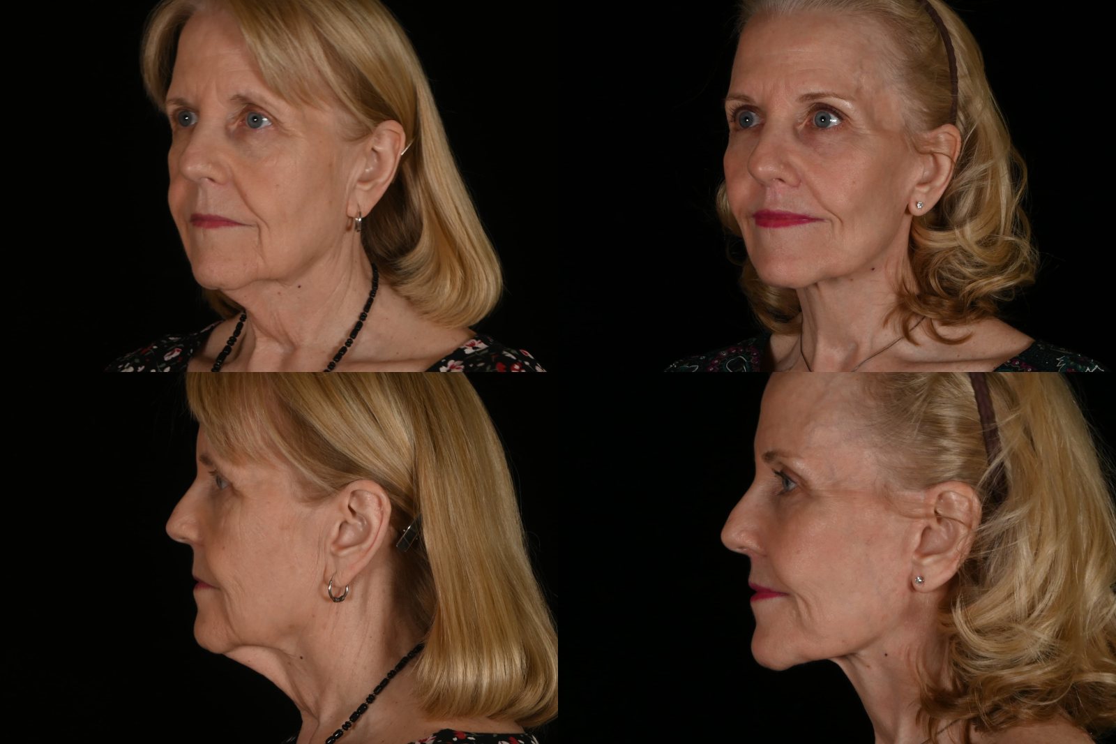Woman, three-quarter view and side view, before and after deep plane facelift and neck lift, lip lift, brow lift, fat grafting and CO2 laser resurfacing. Left column before, right column after.