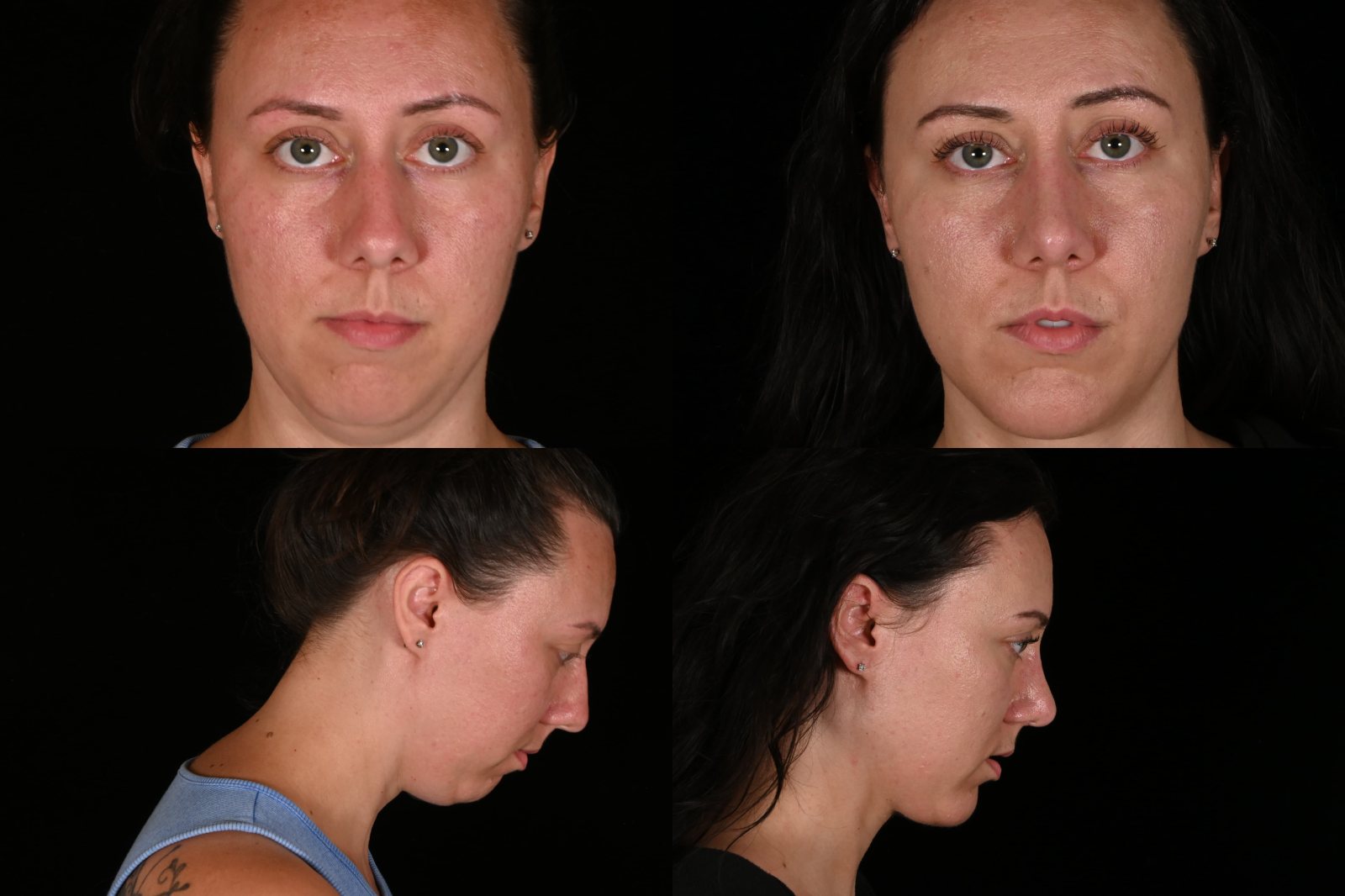 Woman, front view and side view, before and after deep plane facelift and neck lift and rhinoplasty. Left column before, right column after.