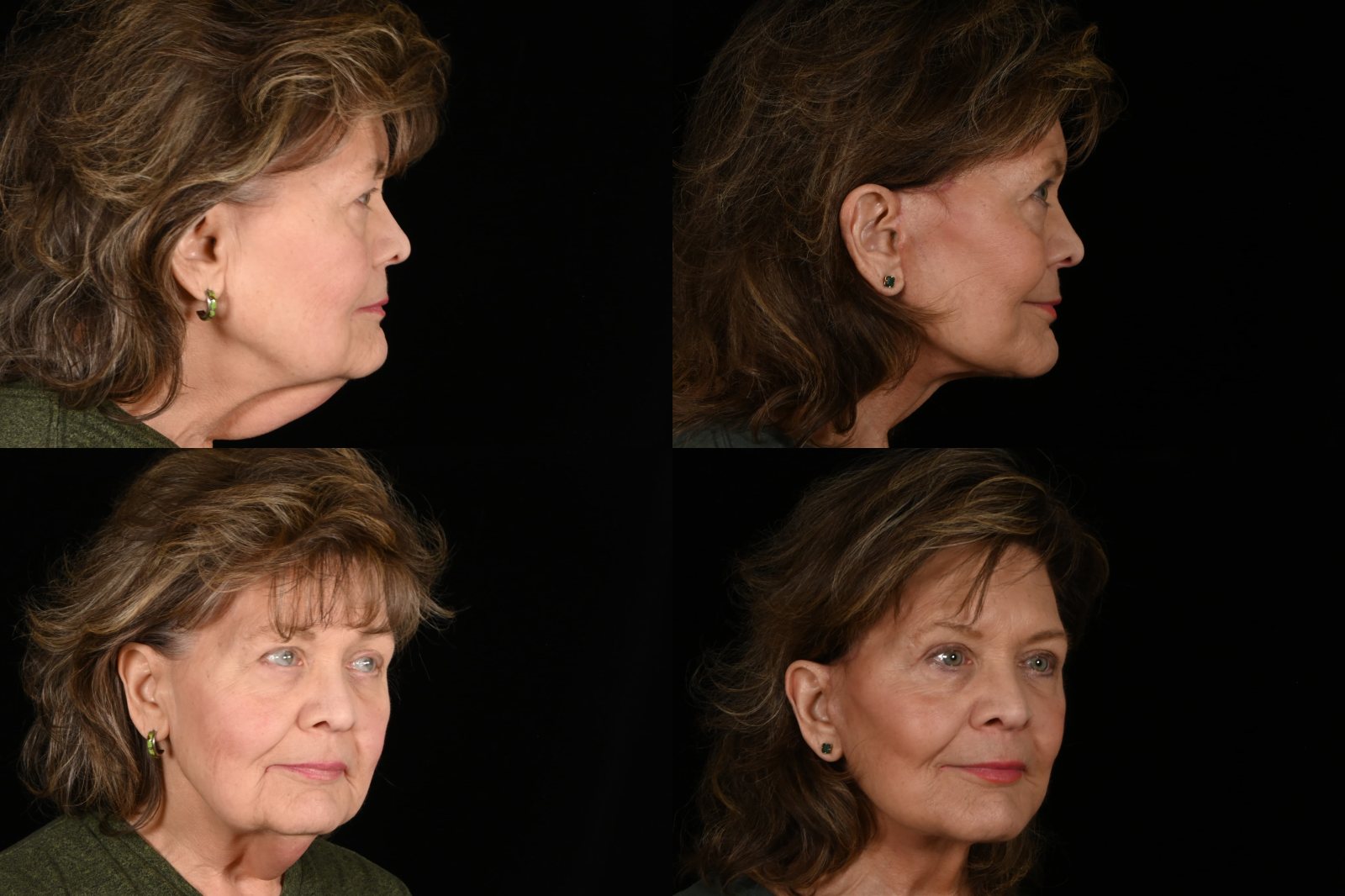 Woman, side view and three-quarter view, before and after deep plane facelift and neck lift, upper blepharoplasty and brow pexy. Left column before, right column after.