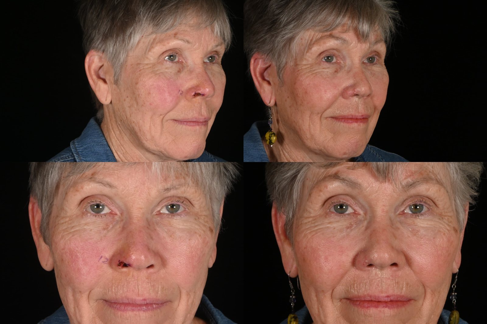 Woman, three-quarter view and front view, before and after reconstruction after Mohs surgery for skin cancer. Left column before, right column after.