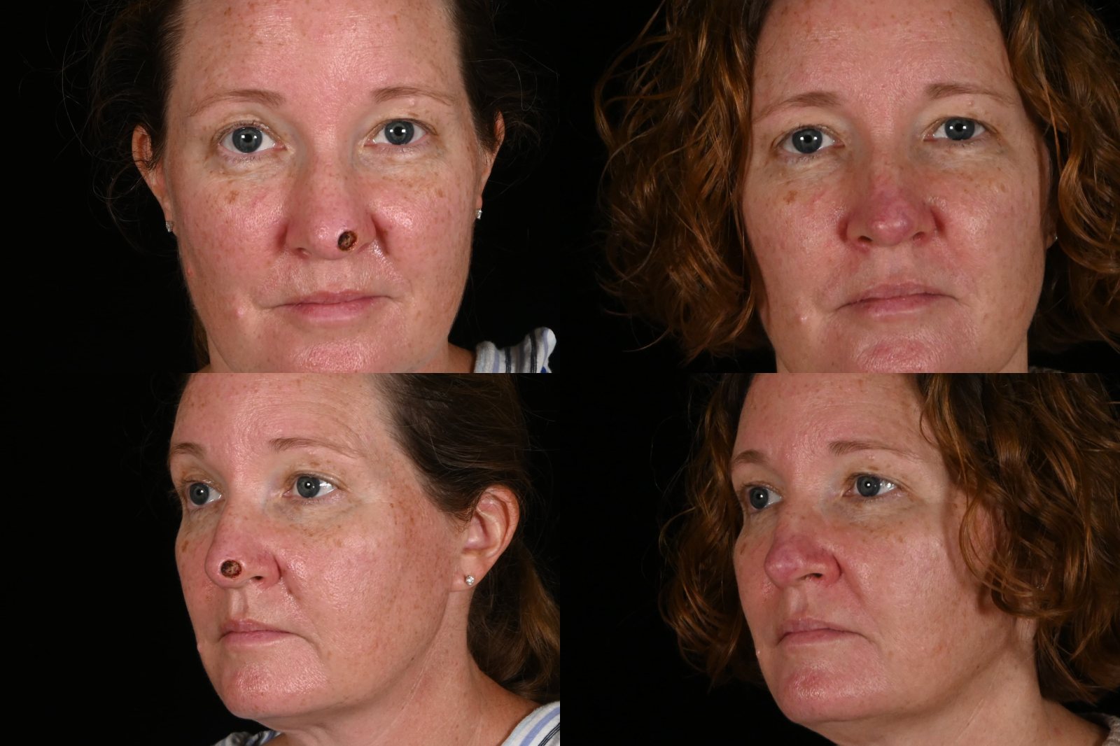 Woman, front view and three-quarter view, before and after reconstruction after Mohs surgery for skin cancer. Left column before, right column after.