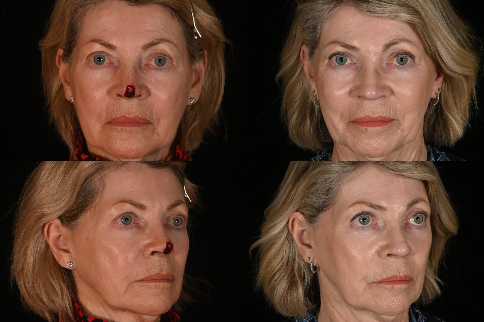 Woman, front view and three-quarter view, before and after nose reconstruction after Mohs surgery for skin cancer. Left column before, right column after.