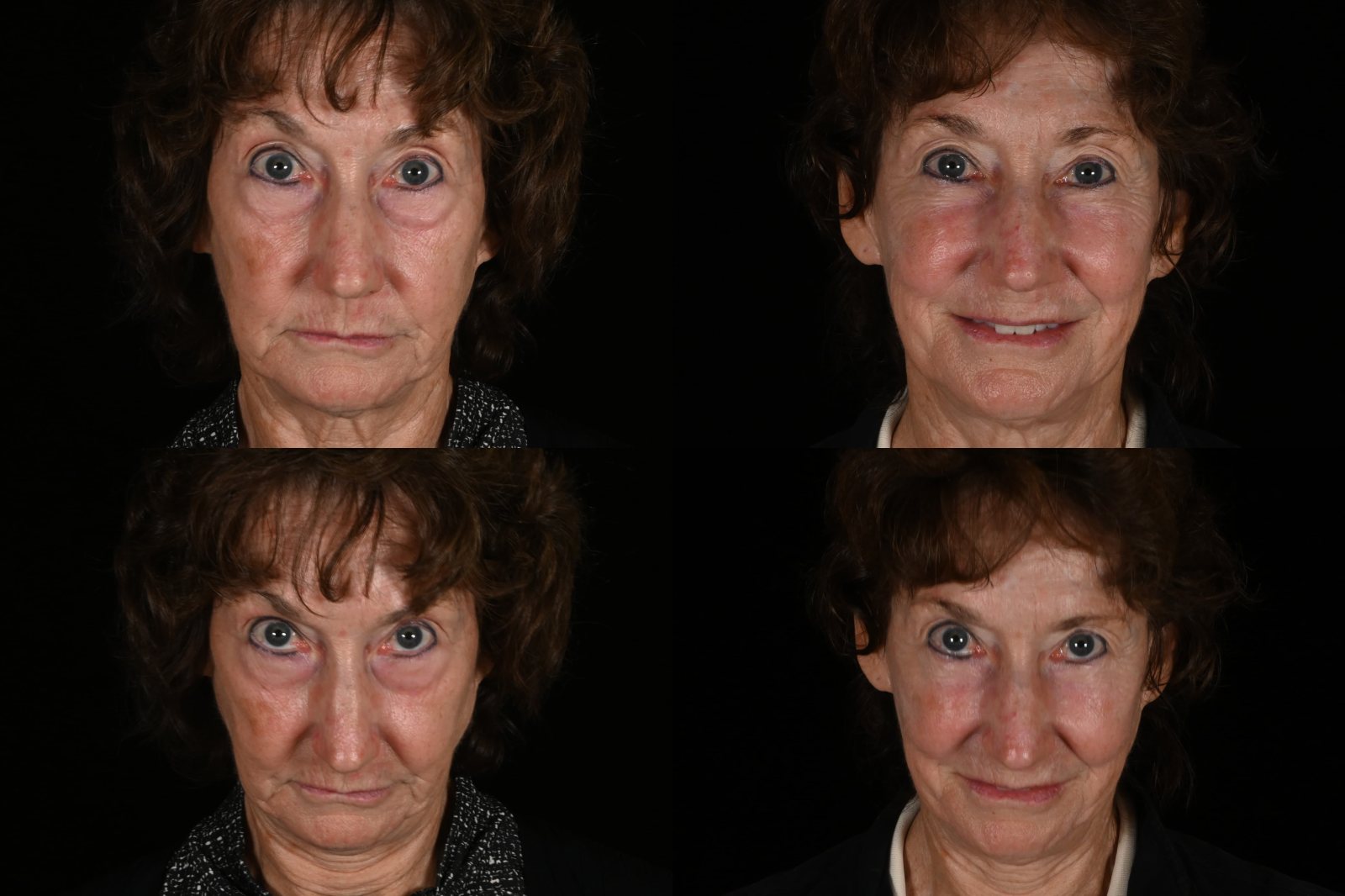 Woman, front view and front view, eyes up, before and after lower blepharoplasty, fat grafting and CO2 laser resurfacing. Left column before, right column after.