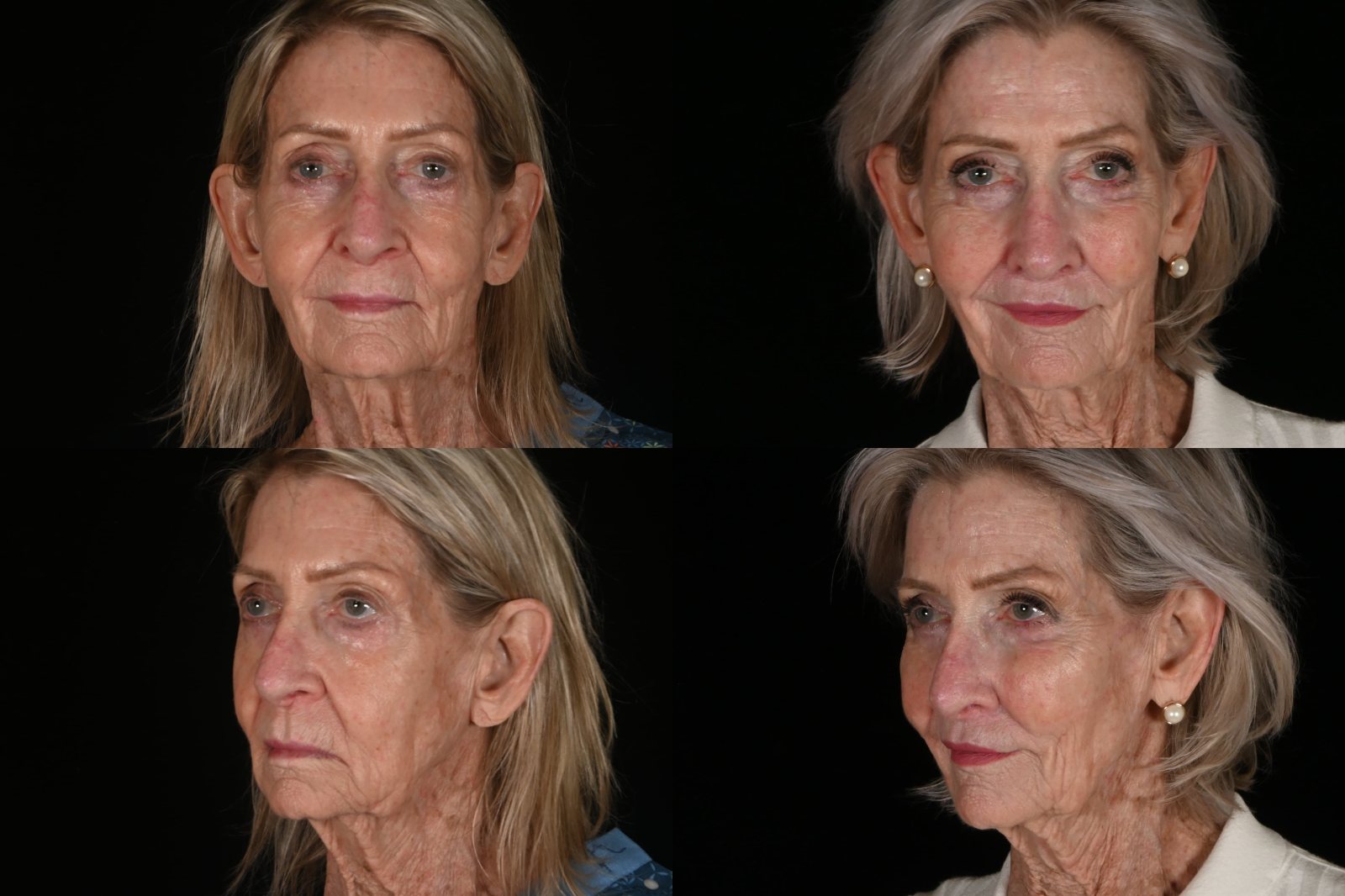 Woman, front view and three-quarter view, before and after lip lift, filler and CO2 laser resurfacing. Left column before, right column after.