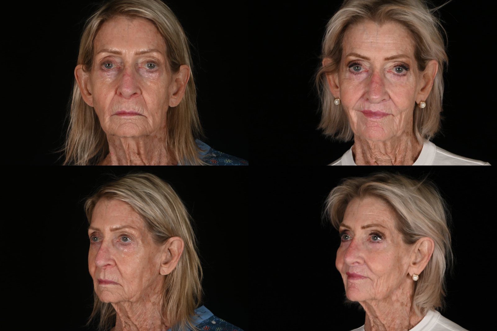 Woman, front view and three-quarter view, before and after filler and CO2 laser resurfacing. Left column before, right column after.
