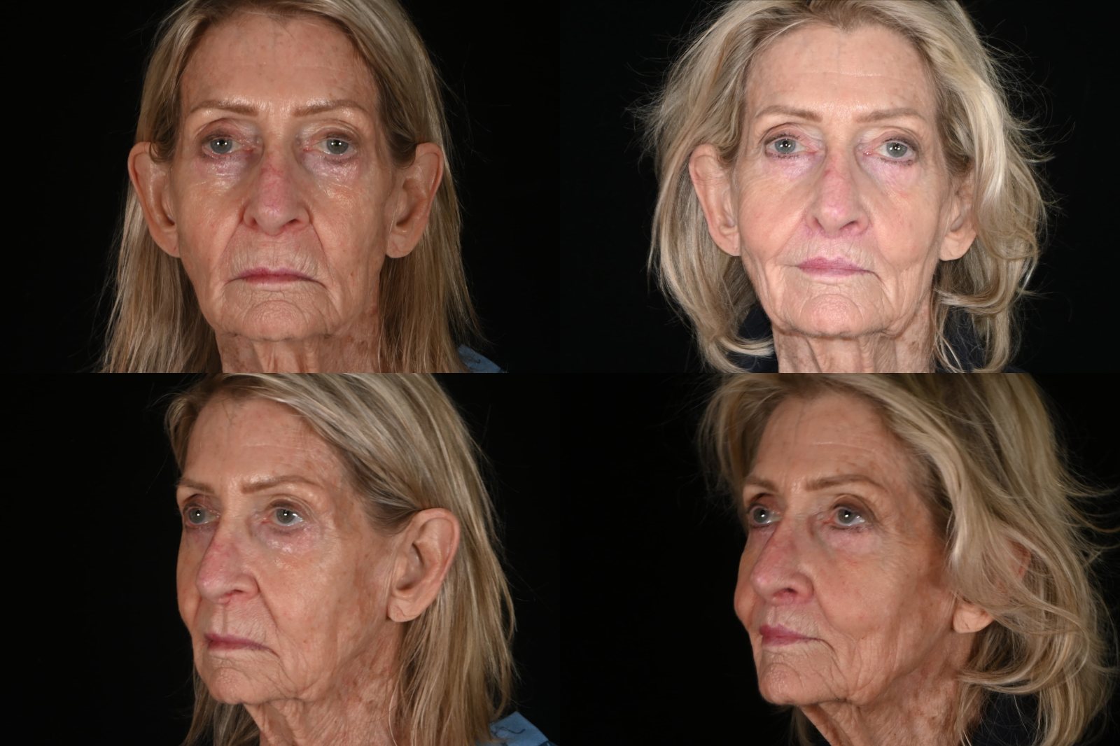 Woman, front view and three-quarter view, before and after filler and CO2 laser resurfacing. Left column before, right column after.
