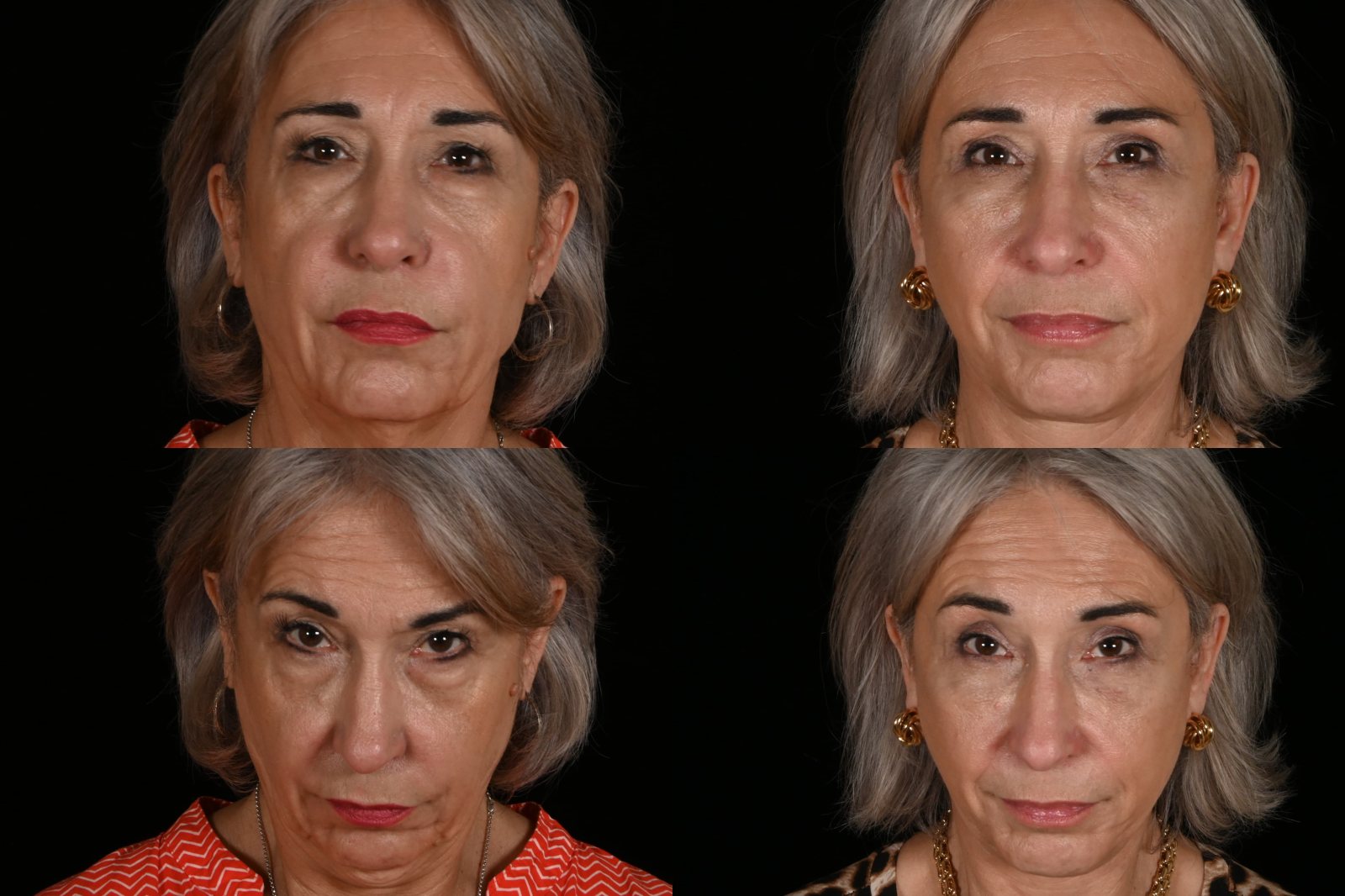 Woman, front view and front view, eyes up, before and after upper and lower blepharoplasty, fat grafting, and deep plane facelift and neck lift. Left column before, right column after.