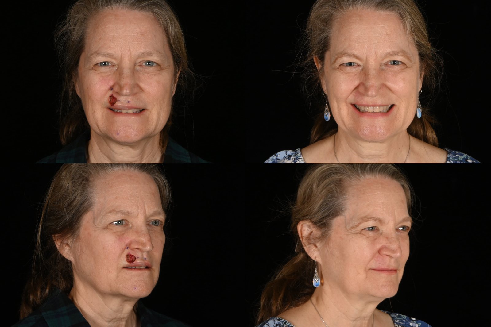 Woman, front view and three-quarter view, before and after lip reconstruction after Mohs surgery for skin cancer. Left column before, right column after.