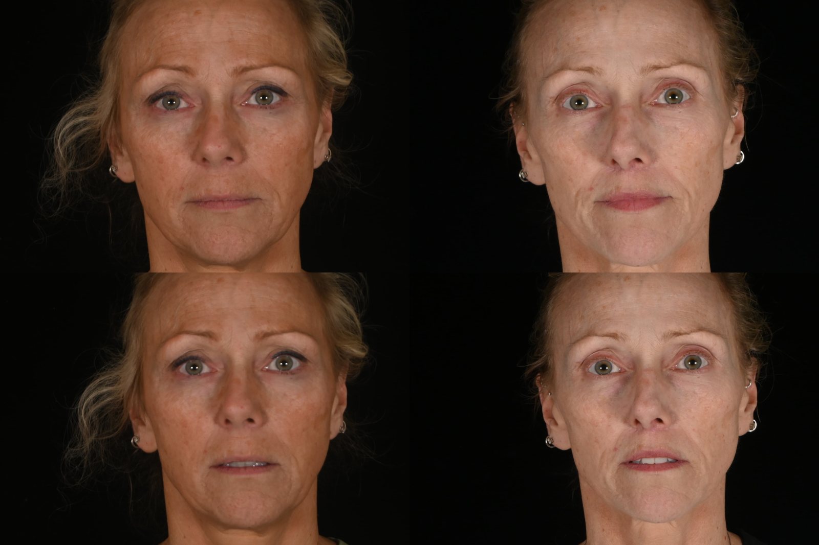 Woman, front view and front view, second photo, before and after lip lift. Left column before, right column after.