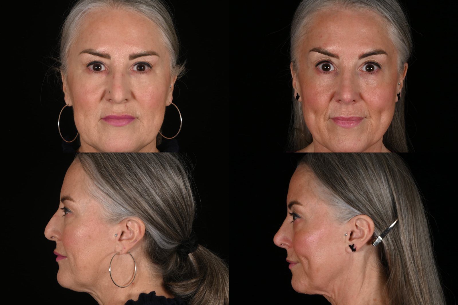 Woman, front view and side view, before and after rhinoplasty. Left column before, right column after.