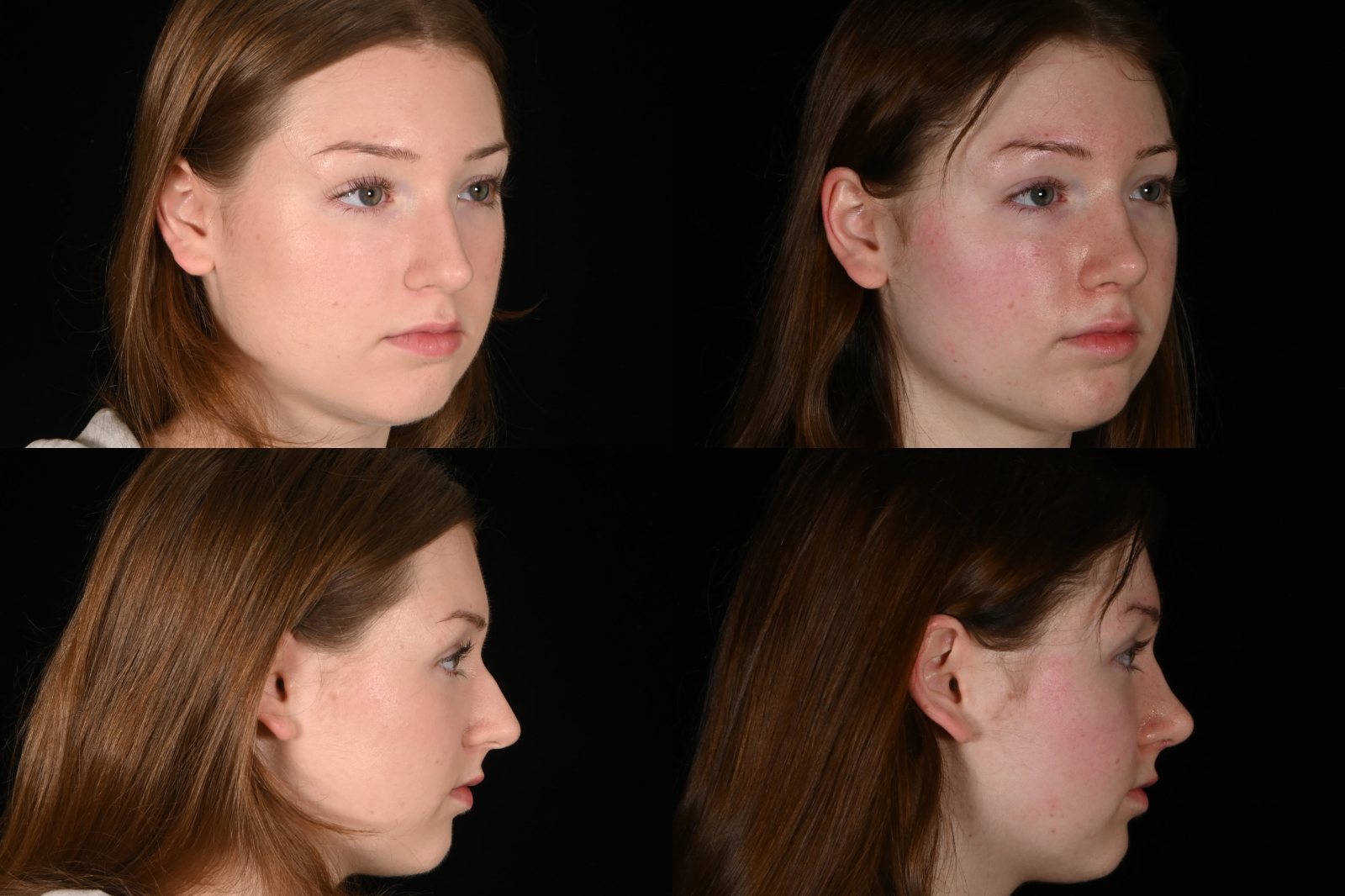 Woman, three-quarter view and side view, before and after rhinoplasty. Left column before, right column after.