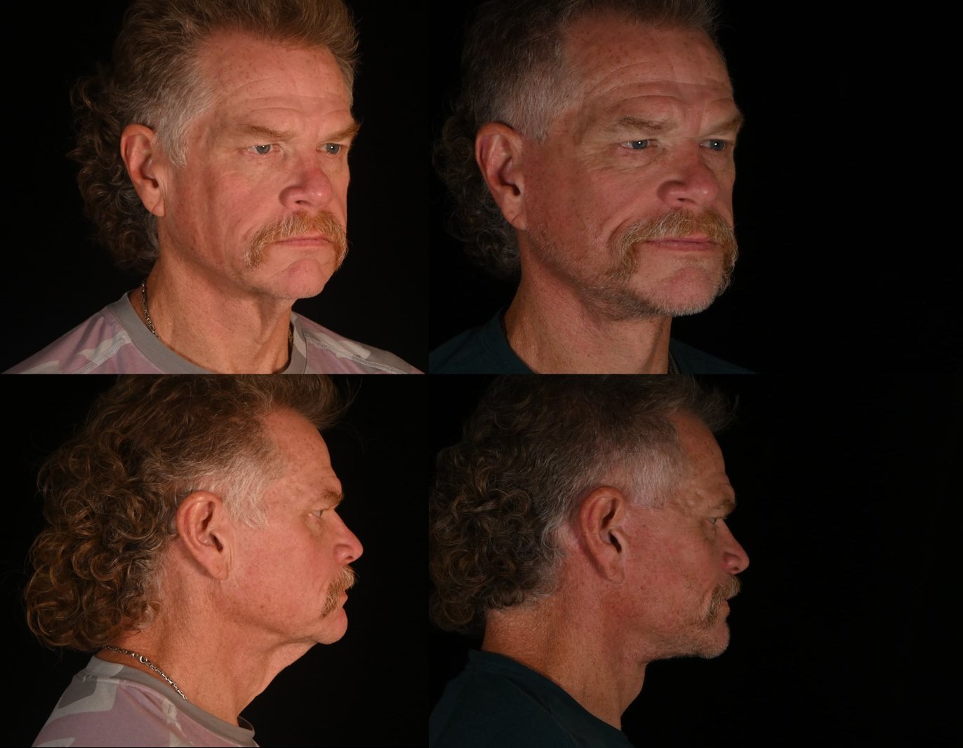 Man, three-quarter view and side view, before and after deep plane facelift and neck lift