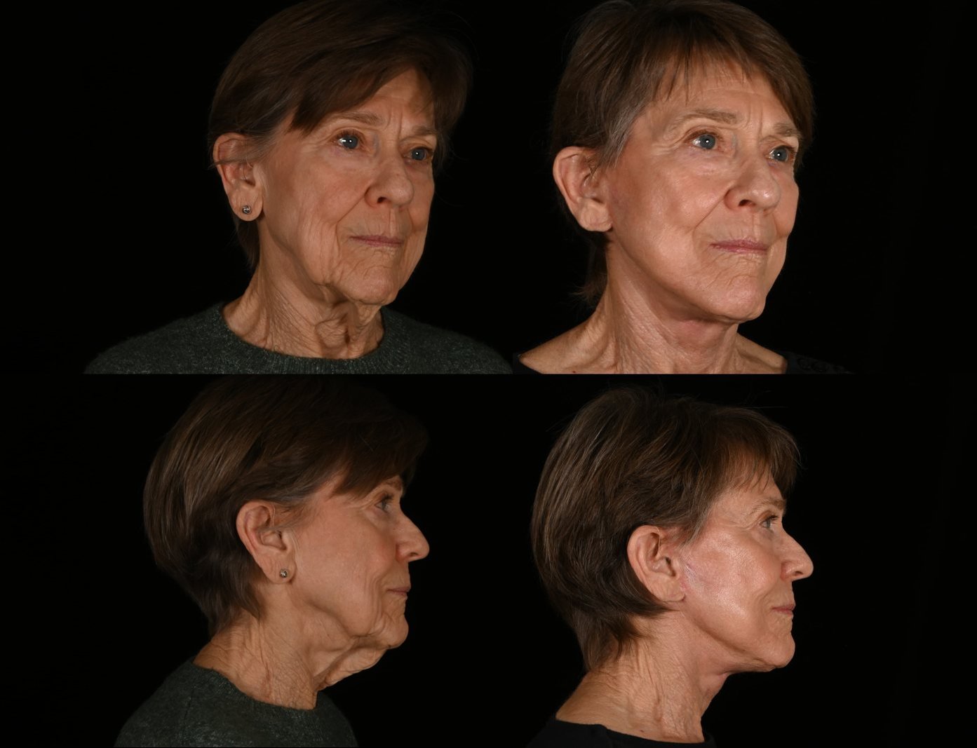 Woman, three-quarter view and side view, before and after deep plane facelift and neck lift
