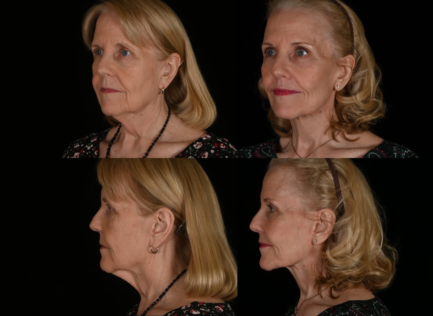 Woman, three-quarter view and side view, before and after deep plane facelift and neck lift, lip lift, brow lift, fat grafting and CO2 laser resurfacing